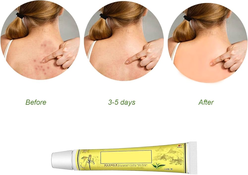 Eczema Psoriasis Creams 5pcs Natural Chinese Herbal Dermatitis and Pruritus Psoriasis Ointment